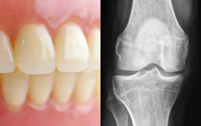 Artificial bones, artificial tooth roots